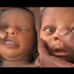 Putting pawpaw water, breast milk in baby’s eyes won’t cure jaundice – Pediatrician